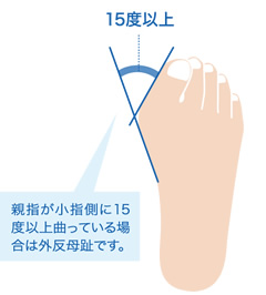 親指が小指側に15度以上曲がっている場合は外反母趾です